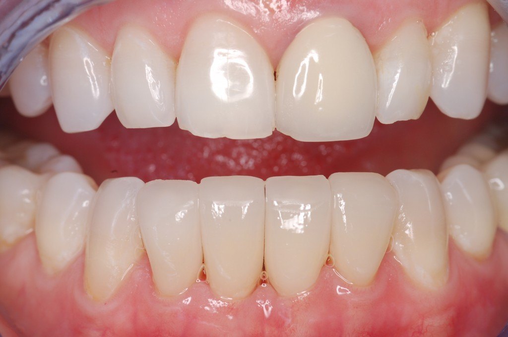 After treating periodontitis