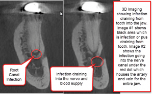 Hidden Root Canal Infections