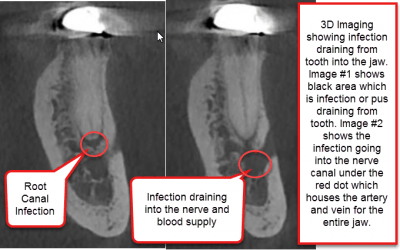 Hidden Root Canal Infections – How We Uncover Long Standing Infections Using 3D Imaging