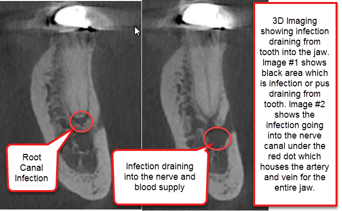 abscessed tooth xray