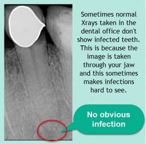 X-Ray of Root Canal Infection