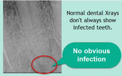 How to Confirm a Root Canal Infection