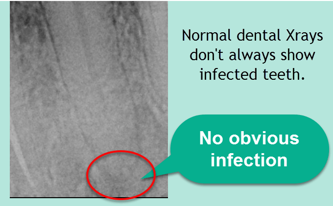 Root Canal Infections