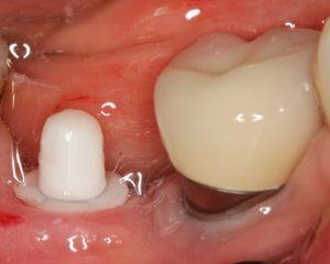 Ceramic vs Titanium Dental Implant
