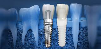 What You Need to Know About Ceramic vs Titanium Dental Implants