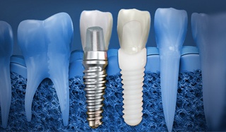 titanium implants