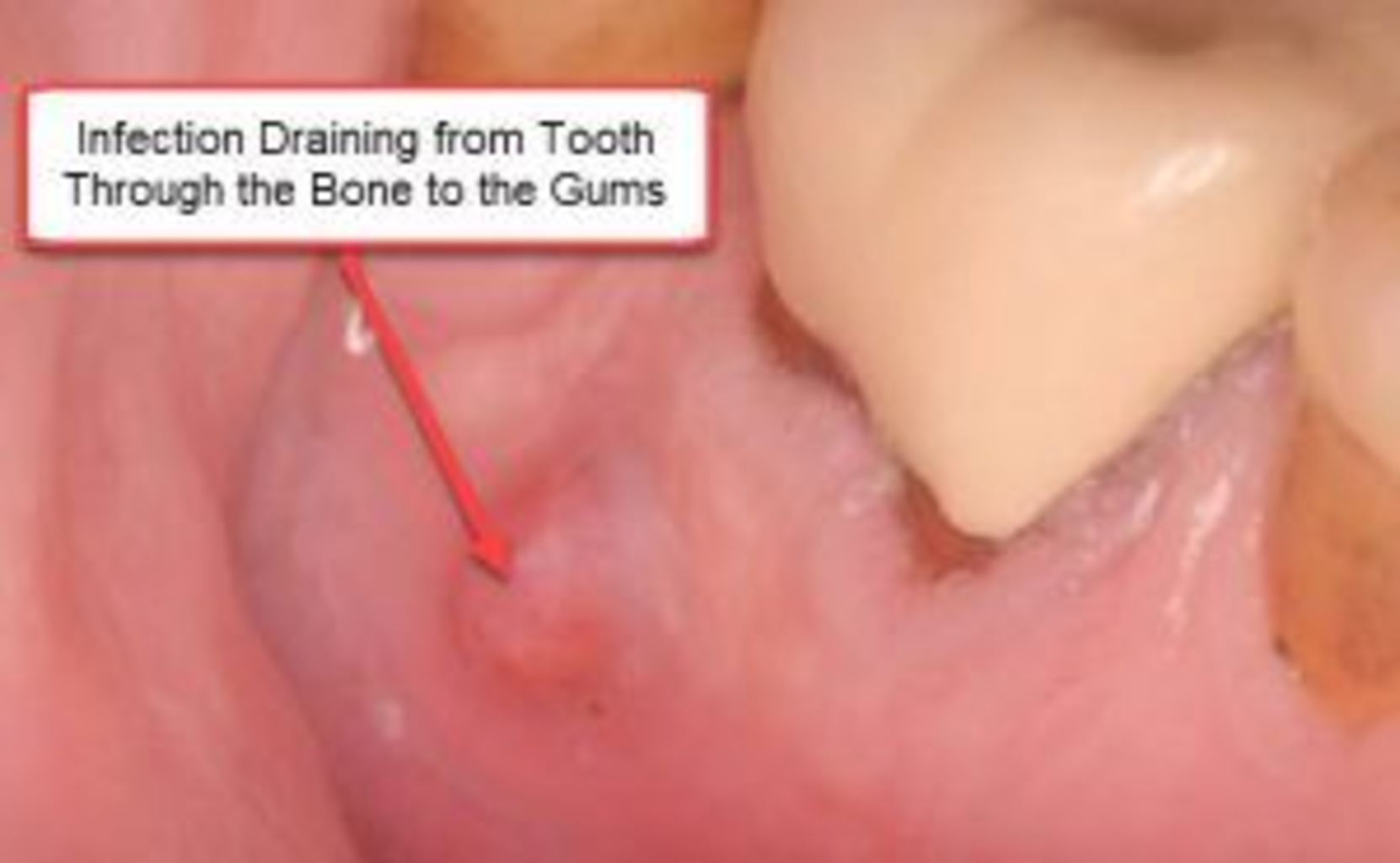 What Causes Root Canal Infections And Failure Integrative