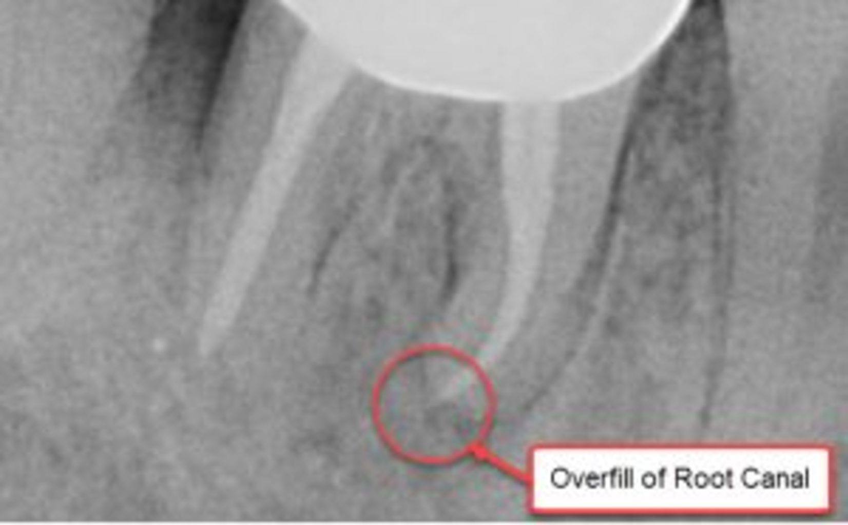 cracked root canal filling