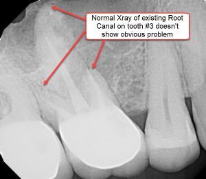 Xray of Existing Root Canal