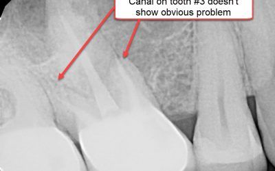 Finally, An Integrative Dentist’s Opinion on Root Canals: The Good, the Bad, and the Ugly