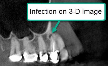 What To Do About Old Root Canal Infections – A Case Study