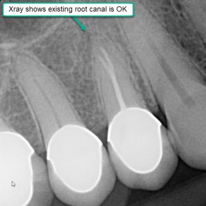 Xray of root canal tooth