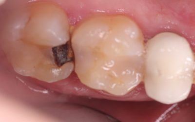 How to Prevent Root Canals With Ozone