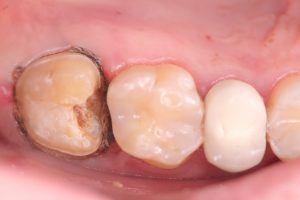 Tooth Treated with Ozone