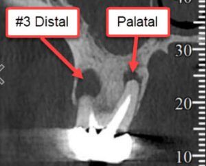 Infected root canal tooth