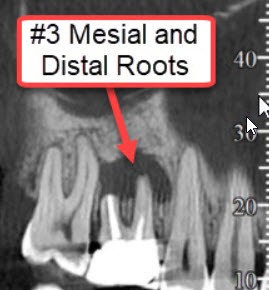 Infected root canal