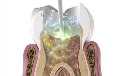 root canal done with laser