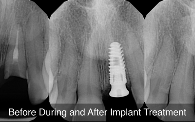 Inflammation May Cause Failure in Extractions, Root Canals and Implants: A Case Study