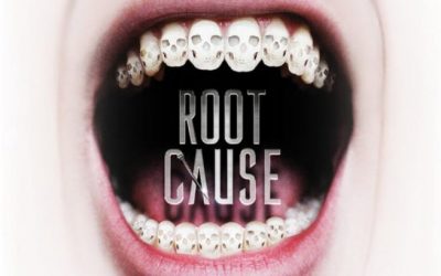 Is The “Root Cause” Movie Right About Root Canals?