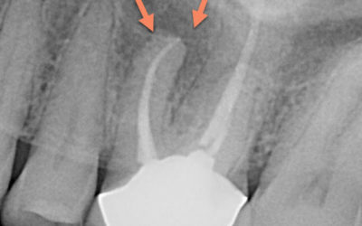 Infected Root Canal to Zirconia Implant – A Case Study