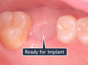 Implant Site