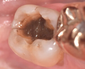 Metal fillings cause tooth cracking