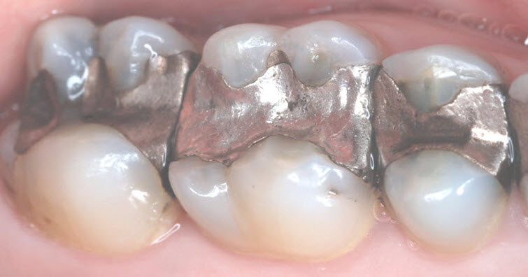 Replacing old amalgams