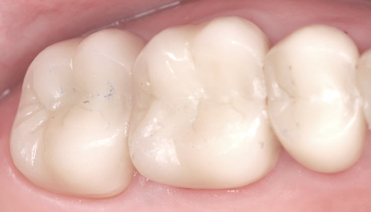 Amalgam removal