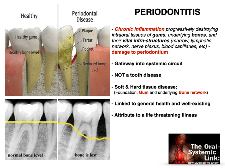 What is Periodontitis