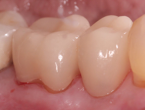 Natural looking porcelain crowns