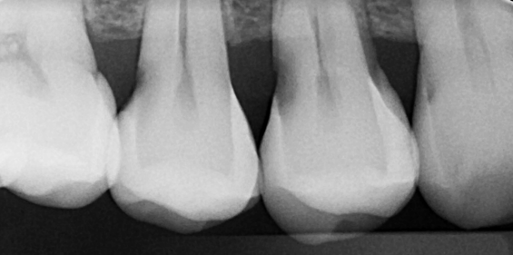 Deep Cavities usually causing Root Canal