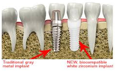 Bio-Friendly Materials for Healthier Smiles