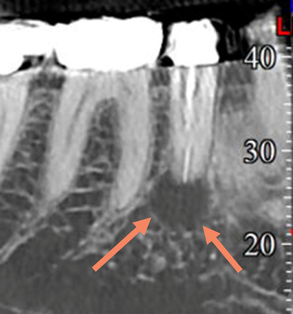 3-D image showing clear root canal infection