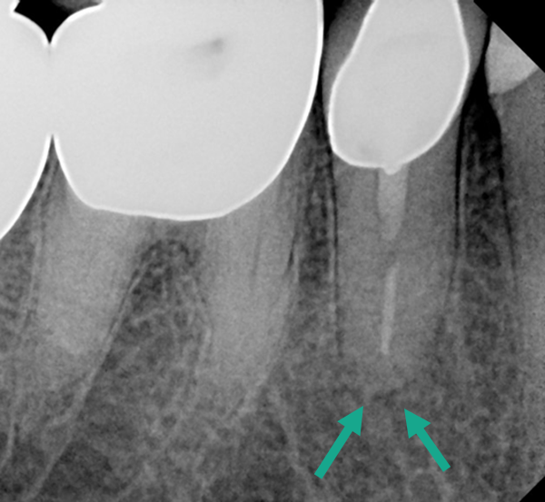 PA X-ray showing no sign of root canal