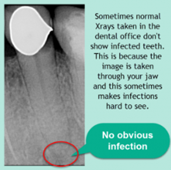 X-ray doesn't always show when a tooth is infected