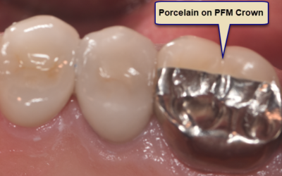 Which is Better a PFM or a Full Porcelain Crown?