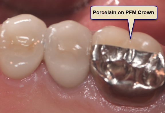 Which is Better a PFM or a Full Porcelain Crown?